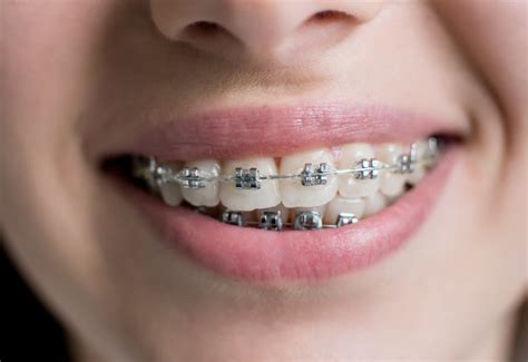 precio de los brackets metalicos|cuanto cuestan los brackets.